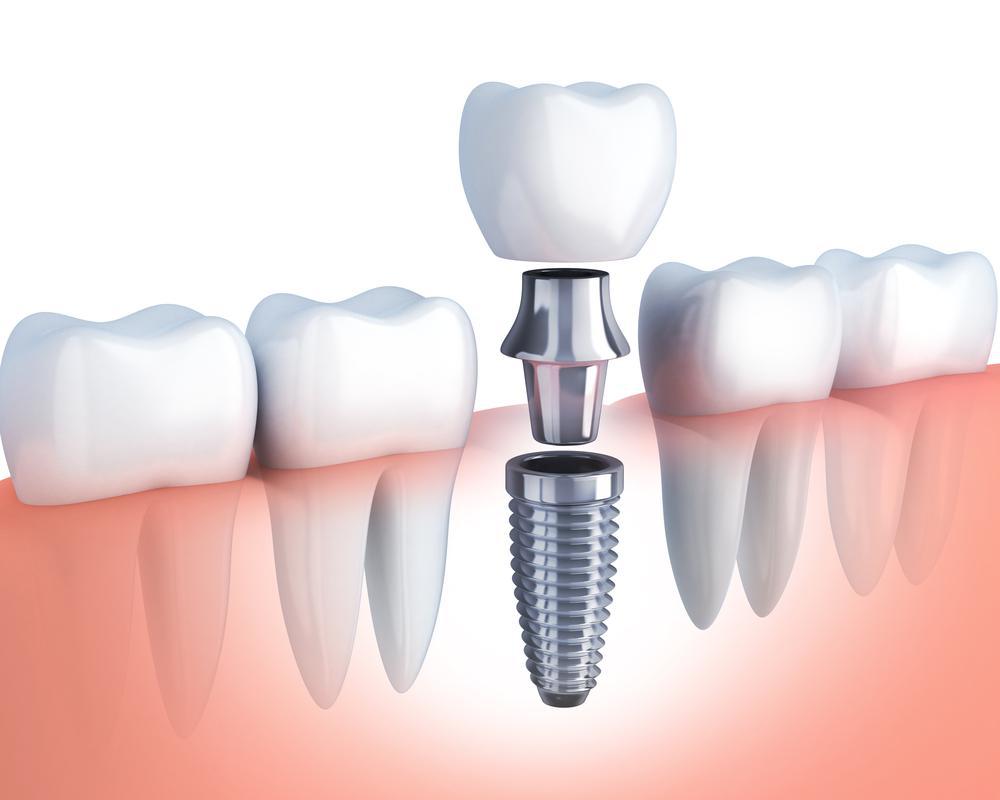 What to Do Before and After Dental Implant Surgery